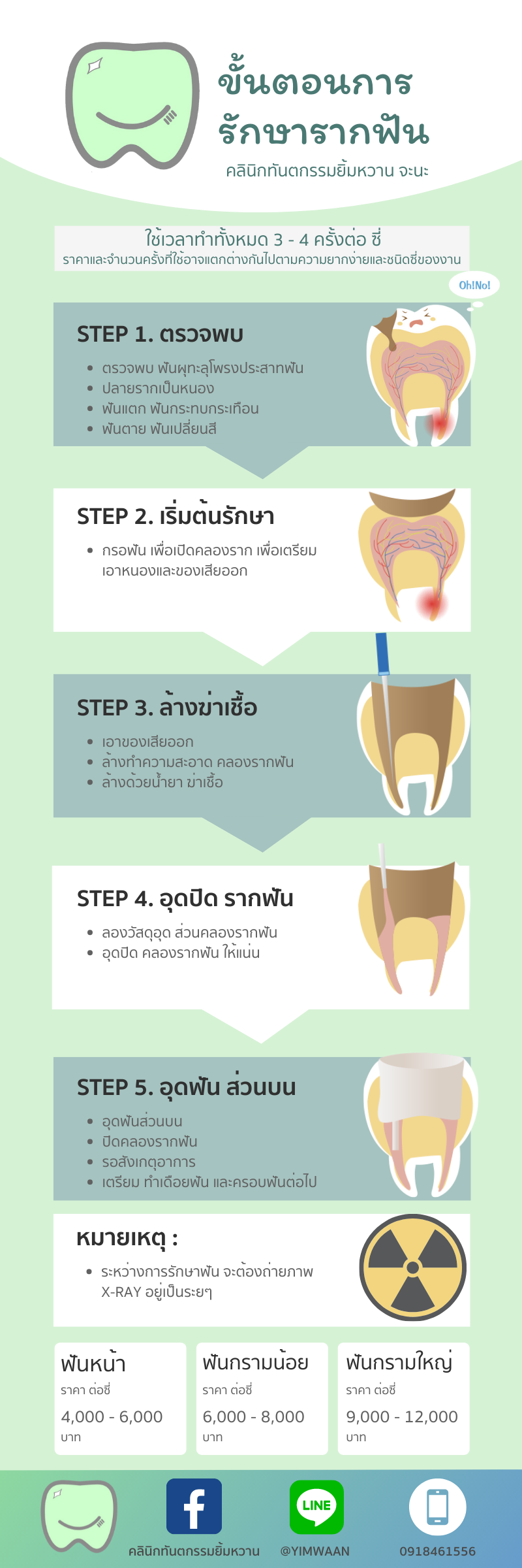 ขั้นตอนรักษาคลองรากฟัน
